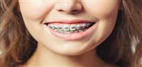 أضرار تقويم الاسنان على المدى البعيد