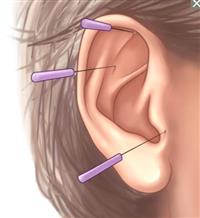 العلاج بالوخز بالإبر
