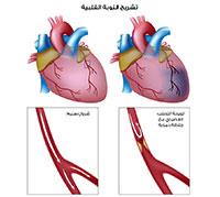 الذبحة الصدرية