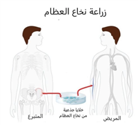 كيف تتم زراعة الخلايا الجذعية و زراعة النخاع