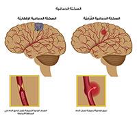  السكتة الدماغية ,,