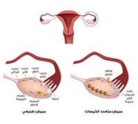  أكياس على المبايض 