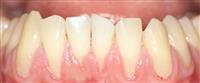 كيف يتم علاج تعري جذور الأسنان ,,,,,,