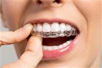 هل استخدام تقويم اسنان شفاف أفضل من المعدني؟