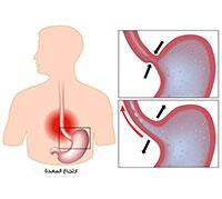  الارتجاع المعدي المريئي ..
