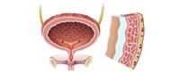 التهاب جدار المثانة: ما هي الأعراض والأسباب؟ 