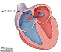 عيوب الحاجز الاذيني