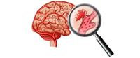 أنواع السكتة الدماغية النزفية وأعراضها 