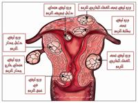 الأورامُ العضليَّة في عنق الرحم 