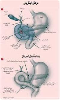 زراعة الكبد والبنكرياس الامال والمخاطر المحتملة