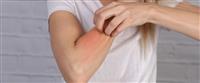  علاج حساسية الجلد كيف يتم وما هي تداعياته؟ 