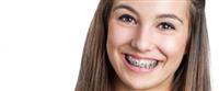  مراحل تقويم الأسنان: أهم المعلومات 