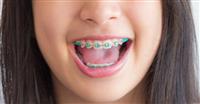 ما هو العمر المناسب لتركيب تقويم الأسنان للأطفال؟
