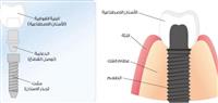 مراحل زراعة الأسنان