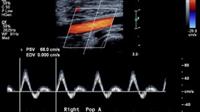أشعة الدوبلكس (الدوبلر الملون) على الأوعية الدموية