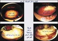 ألياف الرحم علاجها وعلاقتها بالعقم والإخصاب