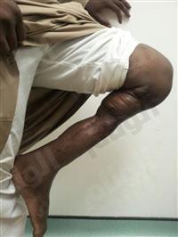 «النور التخصصي» ينجح في ترميم عظام ساق متفتتة لشاب