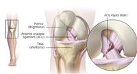 إصابة الرباط الصليبي الأمامي (ACL)