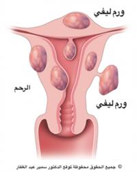 اورام الرحم