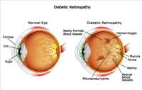 السكري - مضاعفات العين