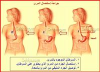 أورام المريء ودور الجراحة