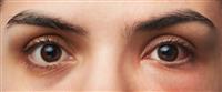  التهاب العين البكتيري: أبرز المعلومات 