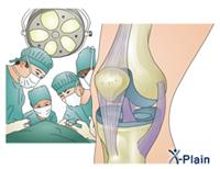 جراحةُ الرُّكبة المفتوحة