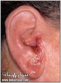 الالتهابات المزمنة في الاذن الخارجية