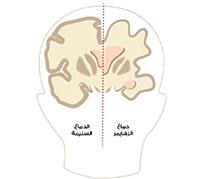  مرض الزهايمر 