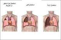  استئصال الرئة 