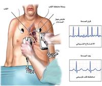 ماهي القثطرة القلبية؟