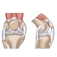  استبدال مفصل الركبة ,, 