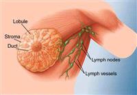 جراحة سرطان الثدي 