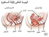 هبوط المهبل الخلفي (الفتاق)