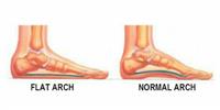 القدم المسطحة عند الأطفال