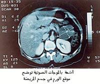 إزالة ورم حميد من البنكرياس