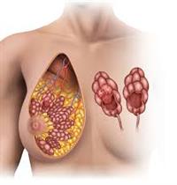 استئصال أورام الثدي 