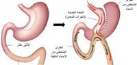 تحويل مسار المعدة