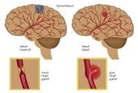 نزيف المخ و انسداد الشرايين المخيه