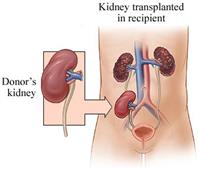 زراعة الكلى : الأسباب والتأهيل والمضاعفات