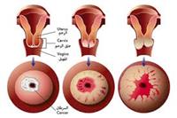 سرطان عـنق الرحم