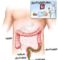 التنظير السجمي المرن ، منظار القولون و المستقيم