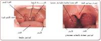 التهاب البلعوم واللوزتين