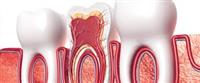 علاج قناة  الجذر