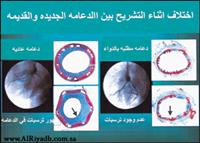 الدعامة المطلية بالدواء