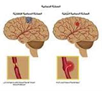 السكتة الدماغية